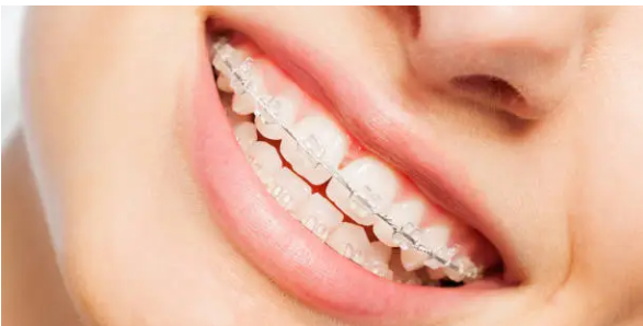 dental braces Adelaide